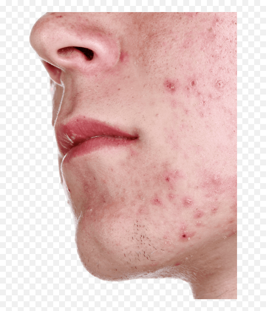 Acne - Acne Images Free Download Png,Pimple Png