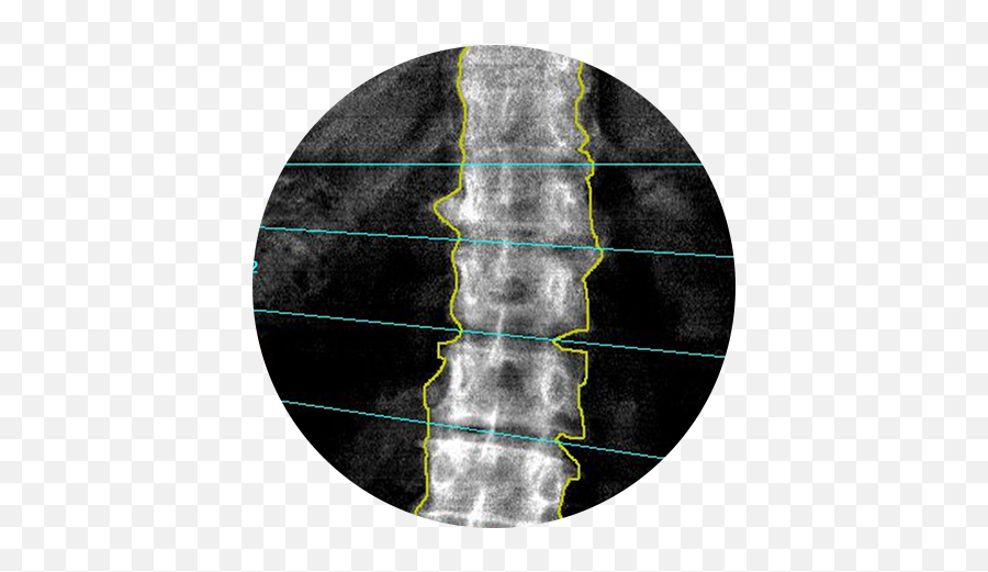 Bone Density Scan Radnet San Fernando Valley - Bone Density Scan Png,Bone Transparent