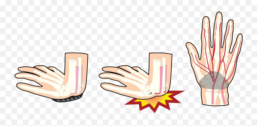 Legs Clipart Bruised Transparent Free For - Sign Language Png,Bruise Transparent