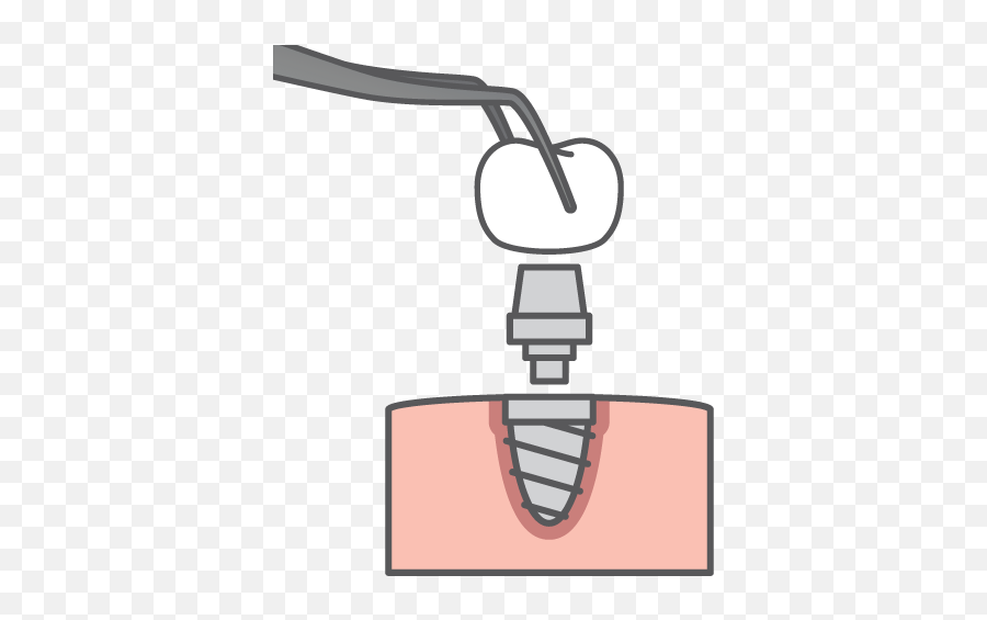 Dental Implants In Spring Tx - Spring Creek Dentistry Dental Implant Cartoon Png,Jawbone Icon Earhook