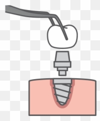 Dental Implants In Spring Tx - Creek Dentistry Cartoon png