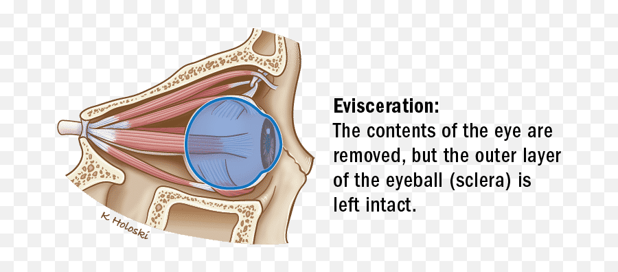 Orbital Eviceration Enucleation U0026 Exenteration Thanc Guide - Superior Rectus Muscle Lateral View Png,Eye Ball Png