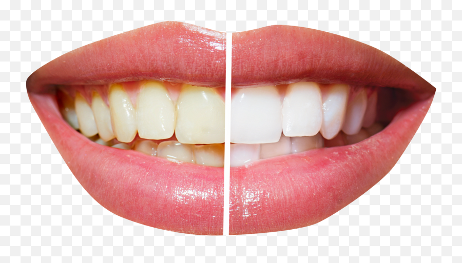 Teeth File Png Transparent Background - Teeth Before And After Cleaning,Teeth Png