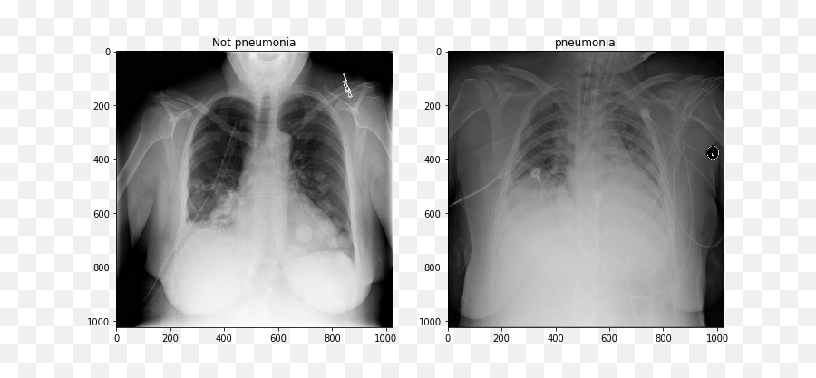 Deep Learning For Detecting Pneumonia From X - Ray Images Pneumonia Vs Normal Chest X Ray Png,X Ray Png