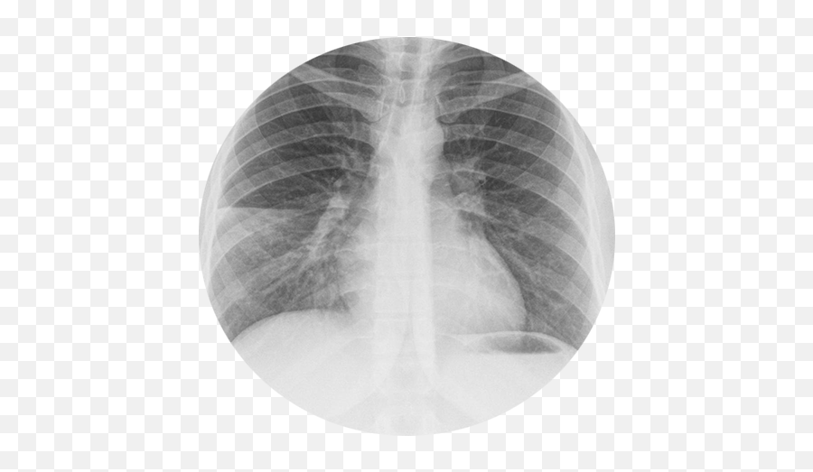 Pneumonia X Ray - Medic Mind Png,X Ray Png