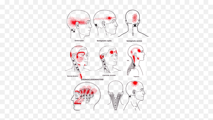 Tension Headaches U2013 Fulton Massage Therapy - Trigger Points In The Neck Png,Headache Png