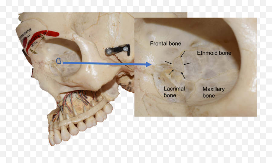 Cureus Wormian Bone Of The Orbit A Case Report - Ethmoid Bone Lacrimal Bone Png,Bone Transparent