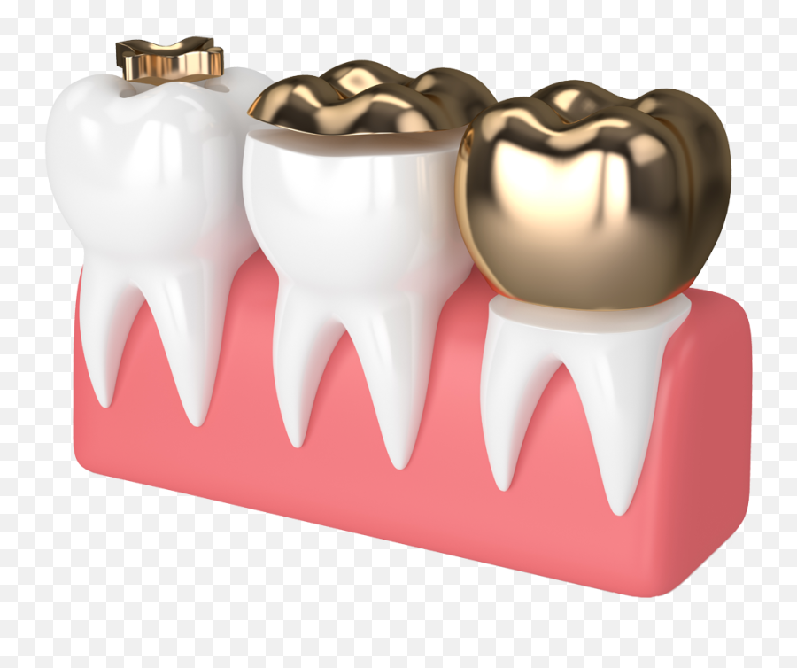 White Fillings - Crown Png,Gold Teeth Png