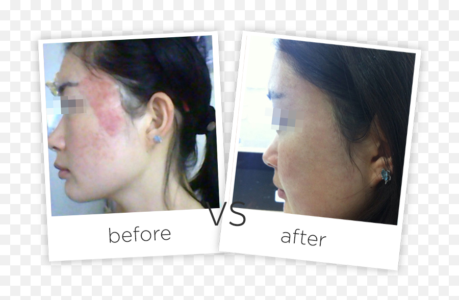Acne Scars Treatment - Adss Laser Number Png,Scars Png