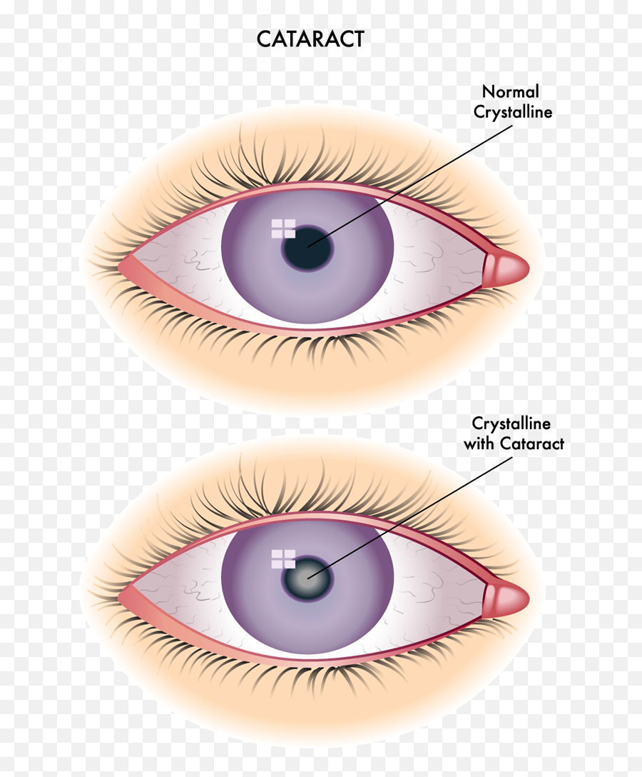 Cataracts Eye Diseases Fishbaugh Family Eyecare - Get Rid Of A Stye Png,Eye Glare Png