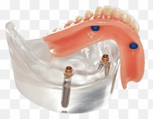 Implant Supported Overdenture U201citu0027s Snapu201d - MyDental Tampa Dentures png