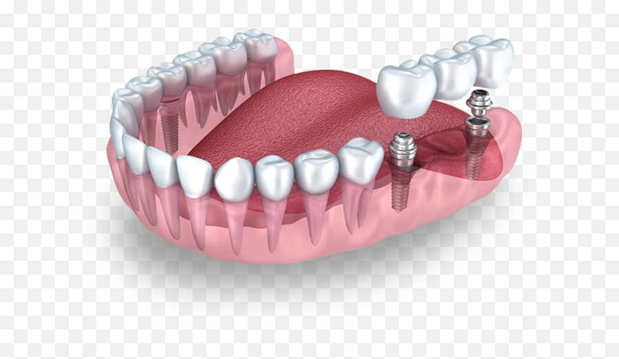 Q And M Home Dental Implant Missing Teeth - Much It Cost A Dental Crown Png,Teeth Png