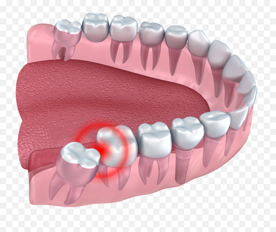 Wisdom Teeth Removal Cardinia Dental - Teeth With Wisdom Teeth Png,Teeth Png