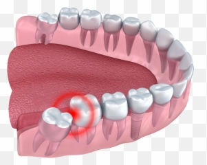 Wisdom Teeth Removal Cardinia Dental - With png