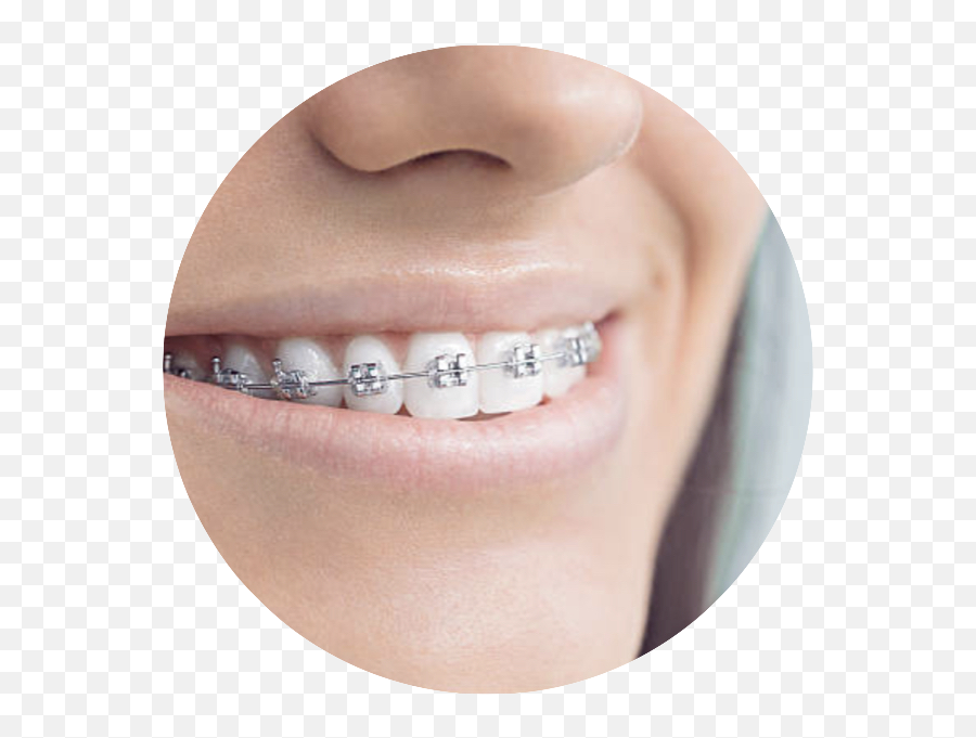 Goldstar Dental - White Bands On Braces Png,Gold Teeth Png