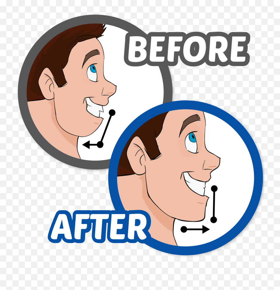 Transparent Braces Drawing Ear - Cartoons With Before And Orthognathic Surgery Clipart Png,Transparent Cartoons
