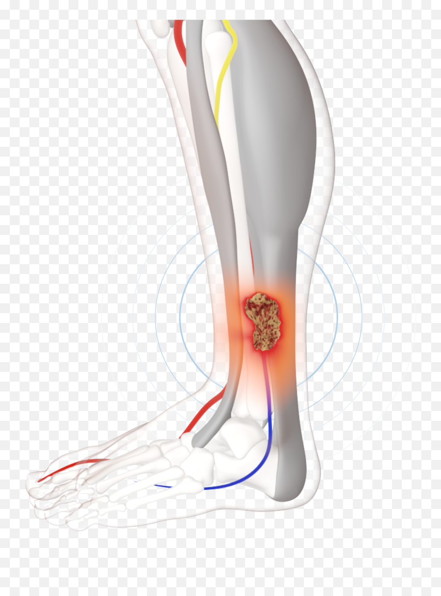 Venous Leg Ulcers - Firstkind Png,Leg Pain Transparent Icon