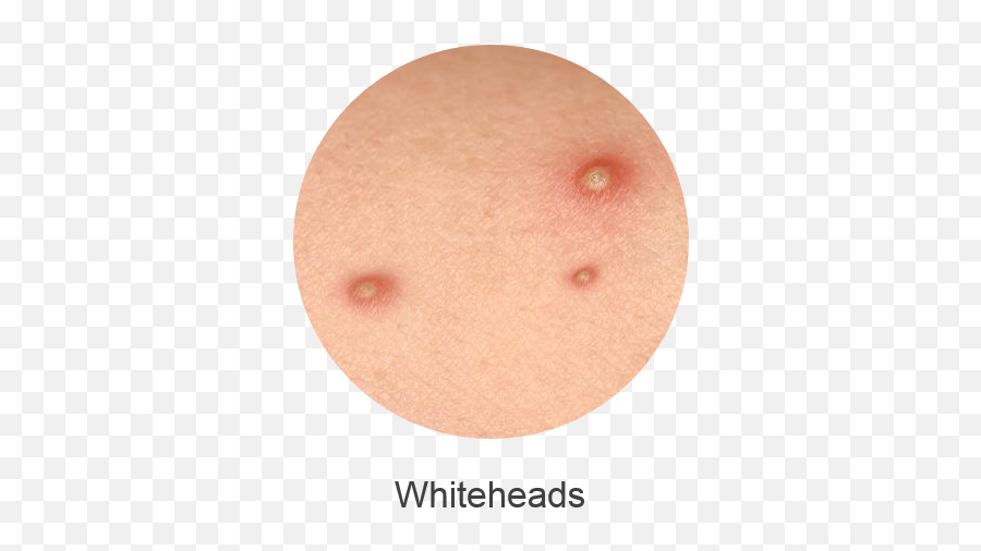 Or Whiteheads Which Result From - Bugaboo Cameleon Off White Png,Pimple Png