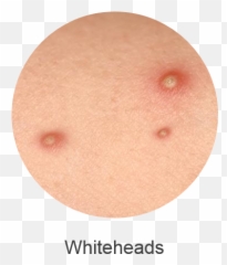 Or Whiteheads Which Result From - Bugaboo Cameleon Off White Png,Pimple Png