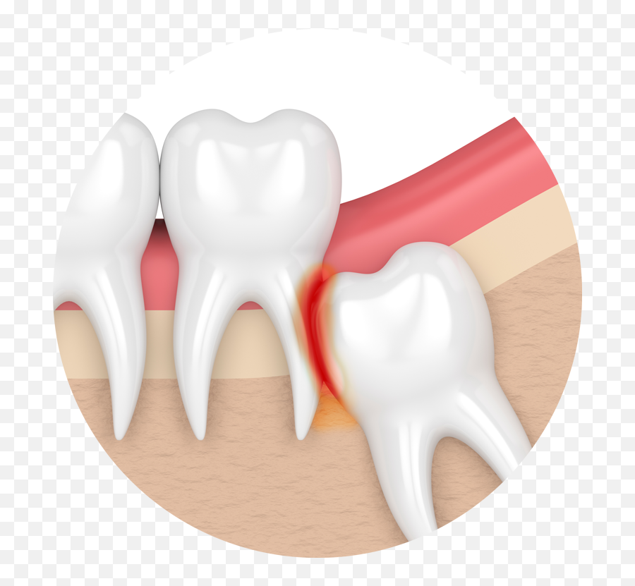 Free Tooth Transparent Background Download Clip Art - Impacted Wisdom Tooth Png,Tooth Clipart Png