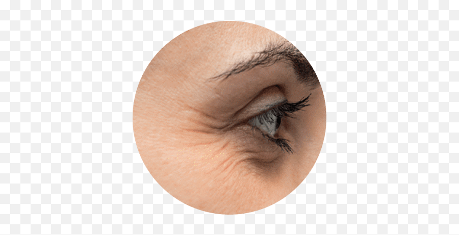 Eye - Rim Treatment Hyamatrixnl Vitamin D Deficiency Skin Face Png,Crying Eyes Png