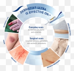 Dermatix Ultra Asia - Before And After Dermatix Ultra Png,Scars Png