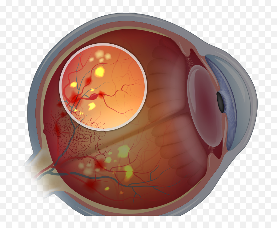 Diabetic Retinopathy Surgery - Diabetic Retinopathy Illustration Png,Diabetes Icon Vector