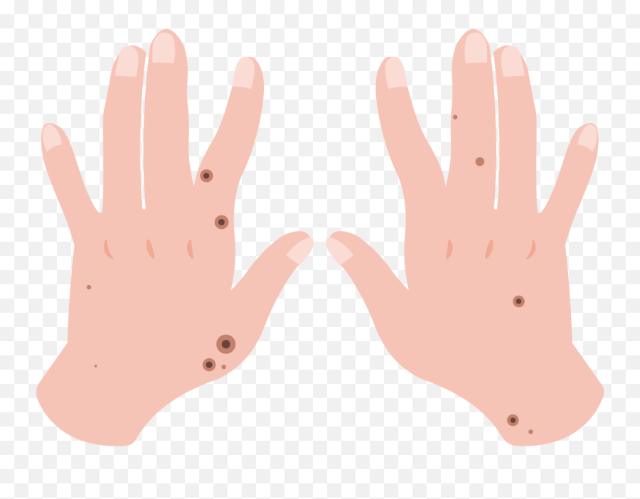 Disseminated Gonococcal Infection Sti Spread U0026 Treatment - Sign Language Png,Hang Loose Icon