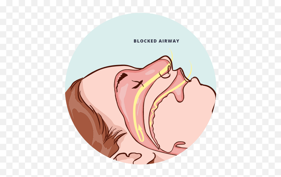 Sleep Apnea Treatment - Florida Dental Sleep Disorders Language Png,Sleep Apnea Icon