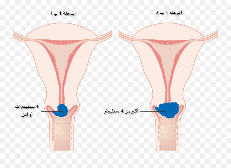 Stage 1b Cervical Cancer Cruk 203 - Stage 1b Cervical Cancer Png,Stage Png