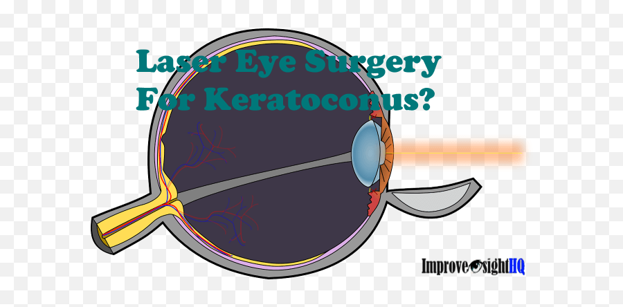 Laser Eye Surgery For Keratoconus Can It Be Used To Improve - Keratoconus Laser Surgery Png,Laser Eyes Png