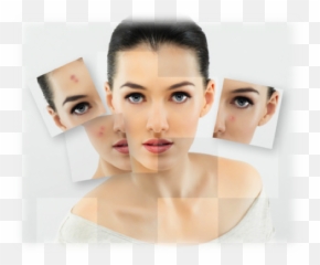 Acne - Mischhaut Und Unreine Haut Png,Pimple Png