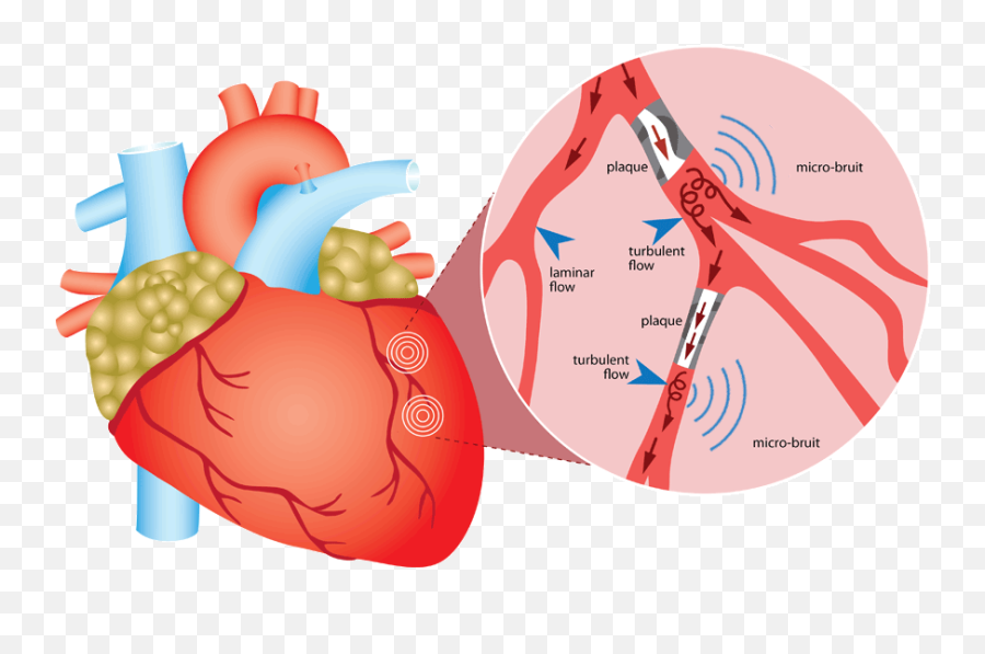 Home Ausculsciences - Coronary Artery Disease Gif Png,Heart Gif Png