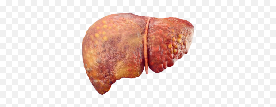 Liver Disease - Types U0026 Common Conditions Information Dr Fats On Liver Png,Liver Icon