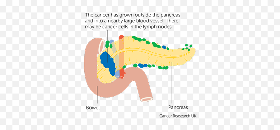 Stage 3 Pancreatic Cancer - Diabetes And Pancreatic Cancer Png,Stage Png