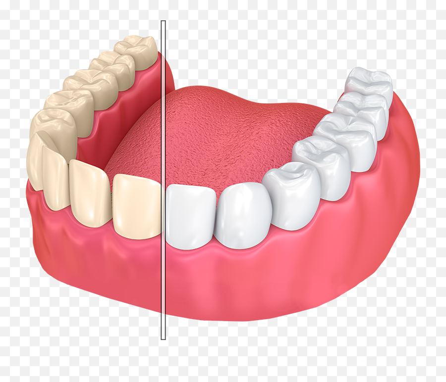 Dentures Transparent Png - Chepped Tooth,Dentures Png