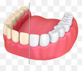 Dentures Transparent Png - Chepped Tooth,Dentures Png