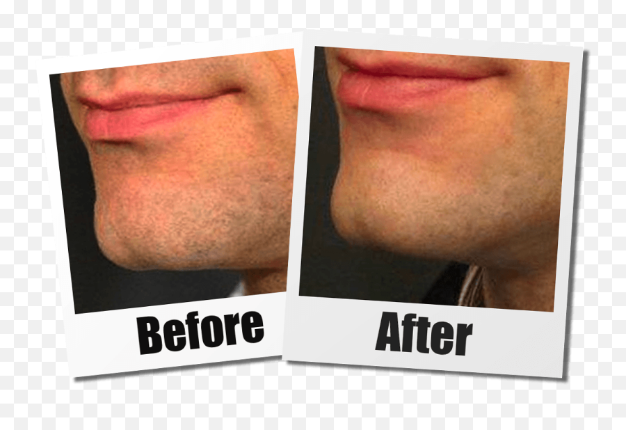 Seattle Chin Implant Non - Surgical Chin Augmentation In Seattle Before And After Microcannula Liposuction Png,Sync Jawbone Icon