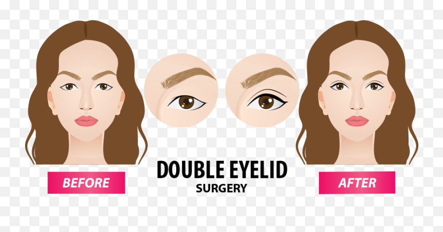 Types Of Double Eyelid Surgery - Girl Png,Eyelid Png