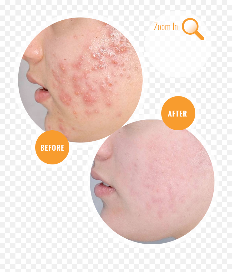 Acne Before And After Treatment - Laserowe Usuwanie Trdziku Efekty Png,Pimple Png