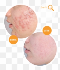 Acne Before And After Treatment - Laserowe Usuwanie Trdziku Efekty Png,Pimple Png