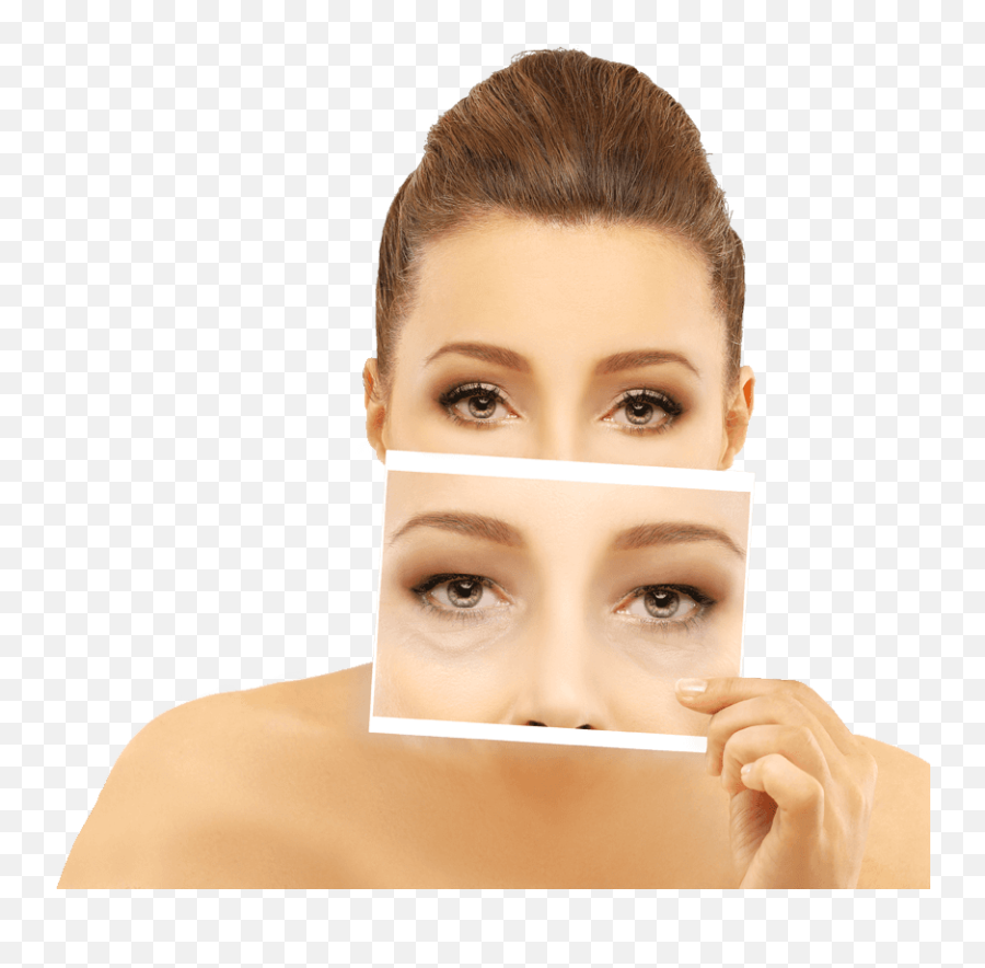 Eyelid Surgery - Eyelid Surgery Blepharoplasty Png,Eyelid Png