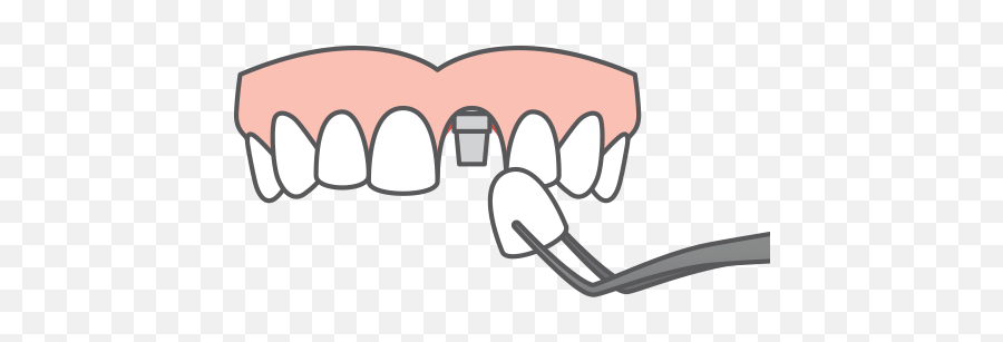 Dental Implant Solutions With Dr Chaudhry Stroudsburg Pa - Dental Prosthesis Icon Png,Dental Implant Icon