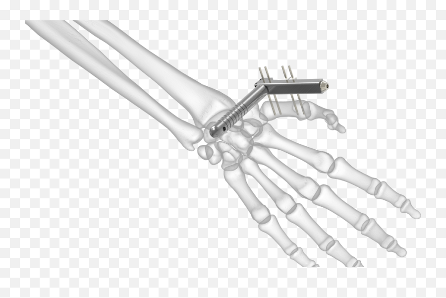 Small Bone Distractor Acumed - Bone Distractor Png,Skeleton Arm Png