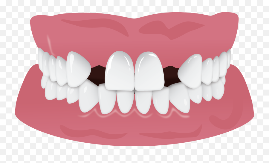 Teeth Smile Png - Missing Teeth Cross Bite 1058195 Vippng Human Tooth,Bite Png