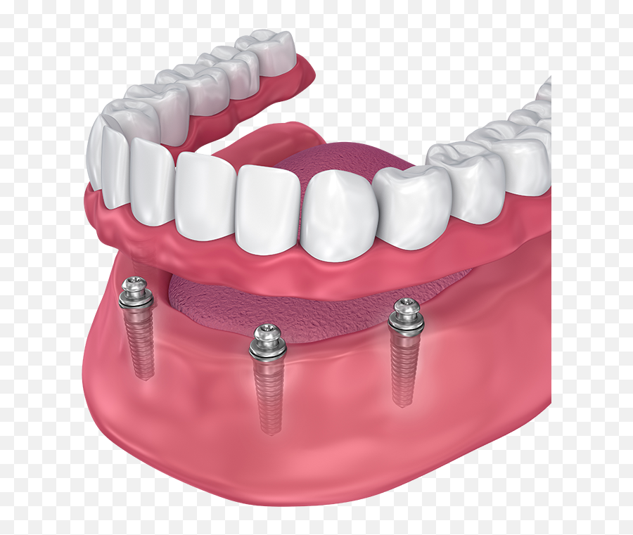 Implant - Implant All On 4 Png,Dentures Png