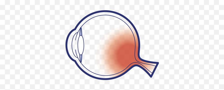 Glaucoma Surgery Brisbane Ophthalmologist U2014 Dr David Gunn Png Laser Eyes