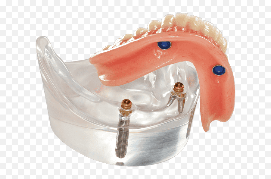 Implant Dentures - Implant Supported Overdenture Png,Dentures Png
