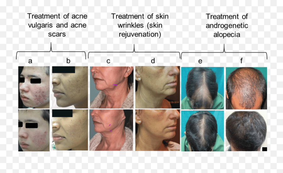 Treatment Against Acne Skin Wrinkles - Collage Png,Wrinkles Png