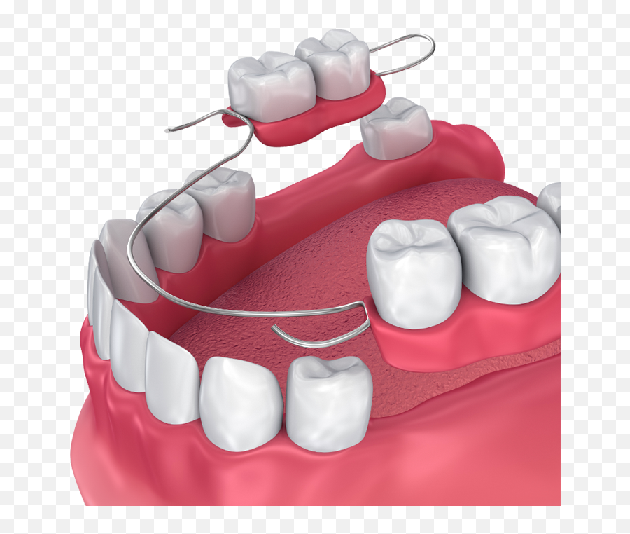 Dentures - Partial Dentures One Tooth Png,Dentures Png
